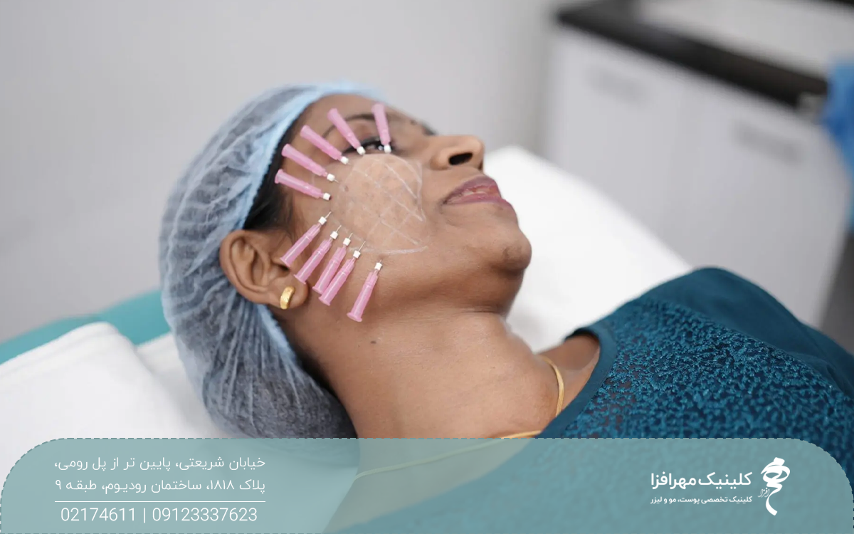 دختری که خوابیده است و کلاه مخصوص روی سرش است و یک سمت صورتش نخ های لیفت قرار گرفته است