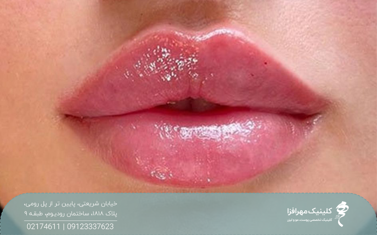 عکس از لب های فردی که ژل لب روسی تزریق کرده است