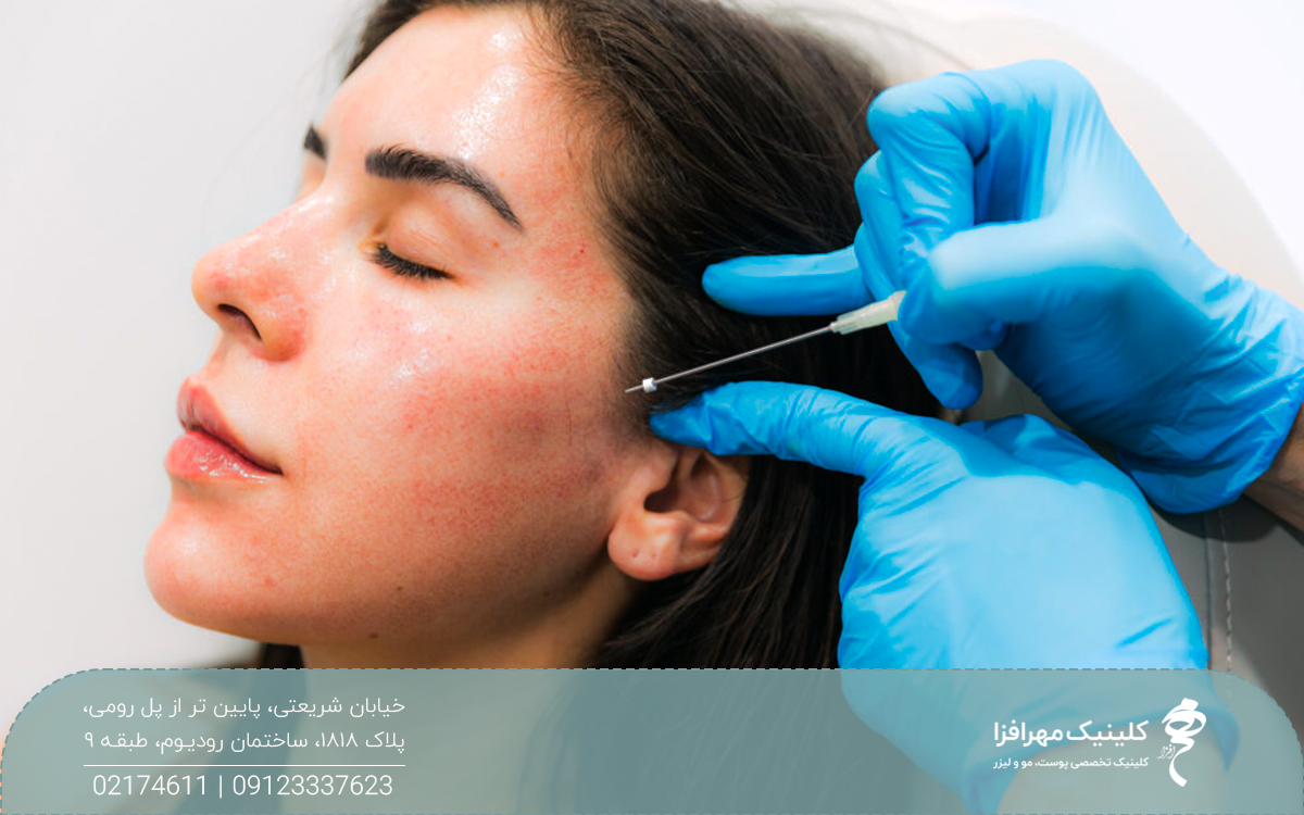 دختری که چشم هایش بسته است و دستان دکتری که در حال انجام لیفت شقیقه با نخ ایست