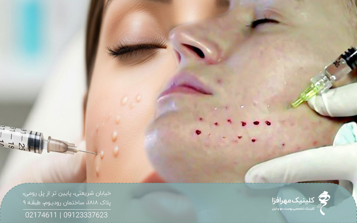 در تصویر صورت دو دختر کنار هم قرار گرفته است و یکی در حال مزوتراپی است و دیگری در حال تزریق مزوژل است - تفاوت مزوژل و مزوتراپی​