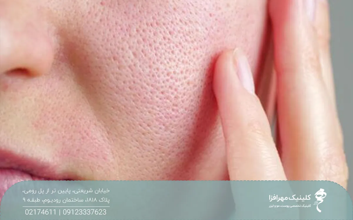 فردی که پوست صورتش منافذ باز دارد و دستش روی صورتش است