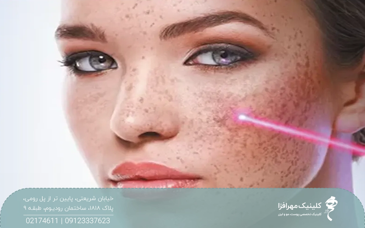 دختری که روی صورتش جای جوش و آکنه دارد و به روبرو نگاه می کند و اشعه لیزر به رنگ قرمز روی صورت او افتاده است
