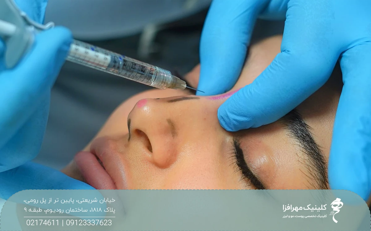 دختری که روی دماغ او با ماژیک علامت گذاری شده و پزشک به بینی او فیلر تزریق می کند