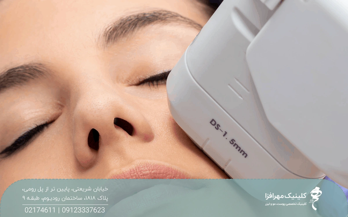 دختری که چشمان او بسته است و هندپیس دستگاه هایفوتراپی روی سمت چپ صورت او قرار دارد