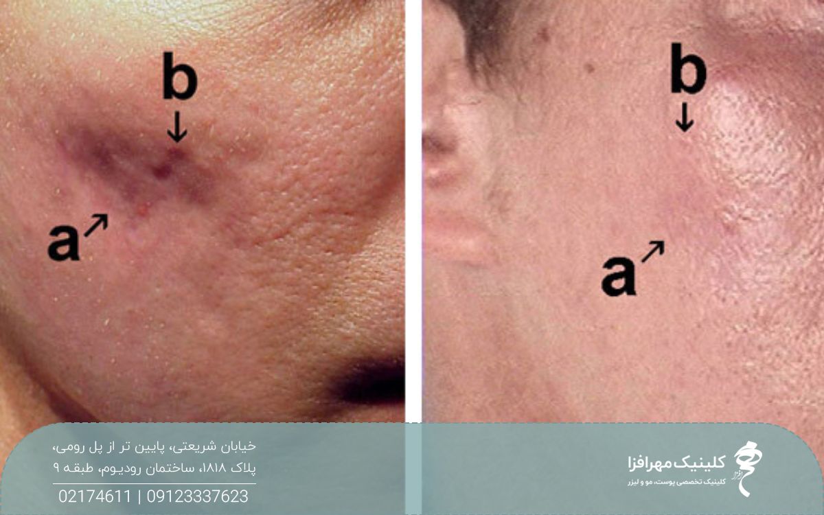 عکس قبل و بعد سابسیژن برای جای جوش که جای اسکار آکنه را از بین برده است