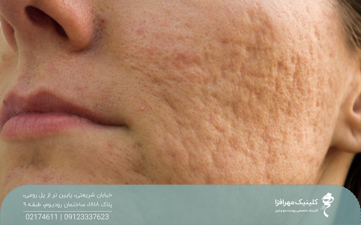 پوست صورت فردی که جای جوش و آکنه زیادی روی صورتش دارد