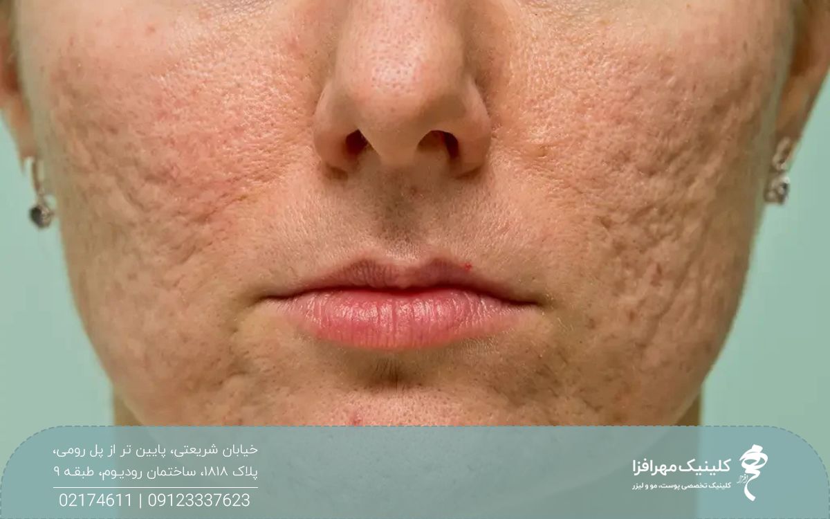 عکس تمام رخ از نیمه پایین صورت زنی که صورت او را اسکار آکنه پوشانده است