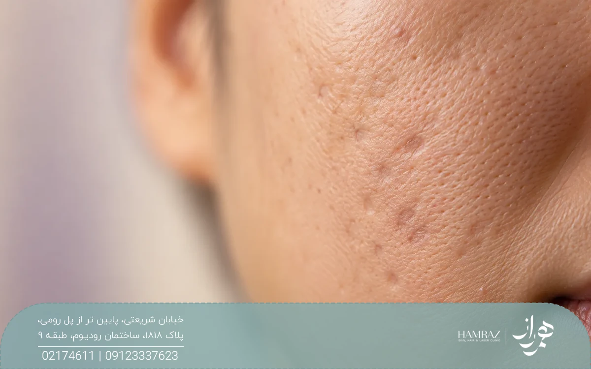پوست صورت دختری که اسکار آکنه دارد