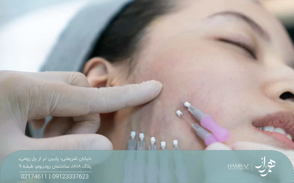 دختری که چشم خود را بسته و صورت خود را به یک طرف مایل کرده است که پزشک نخ لیفت را وارد پوست صورت او کرده است